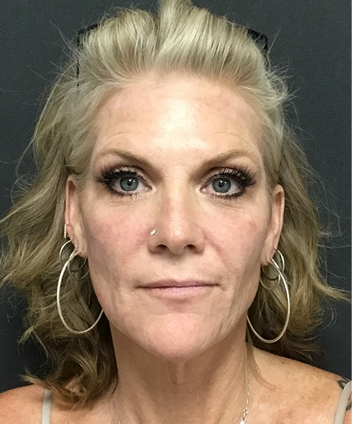 Bellafill injectable treatment for long-lasting wrinkle reduction and acne scar improvement.