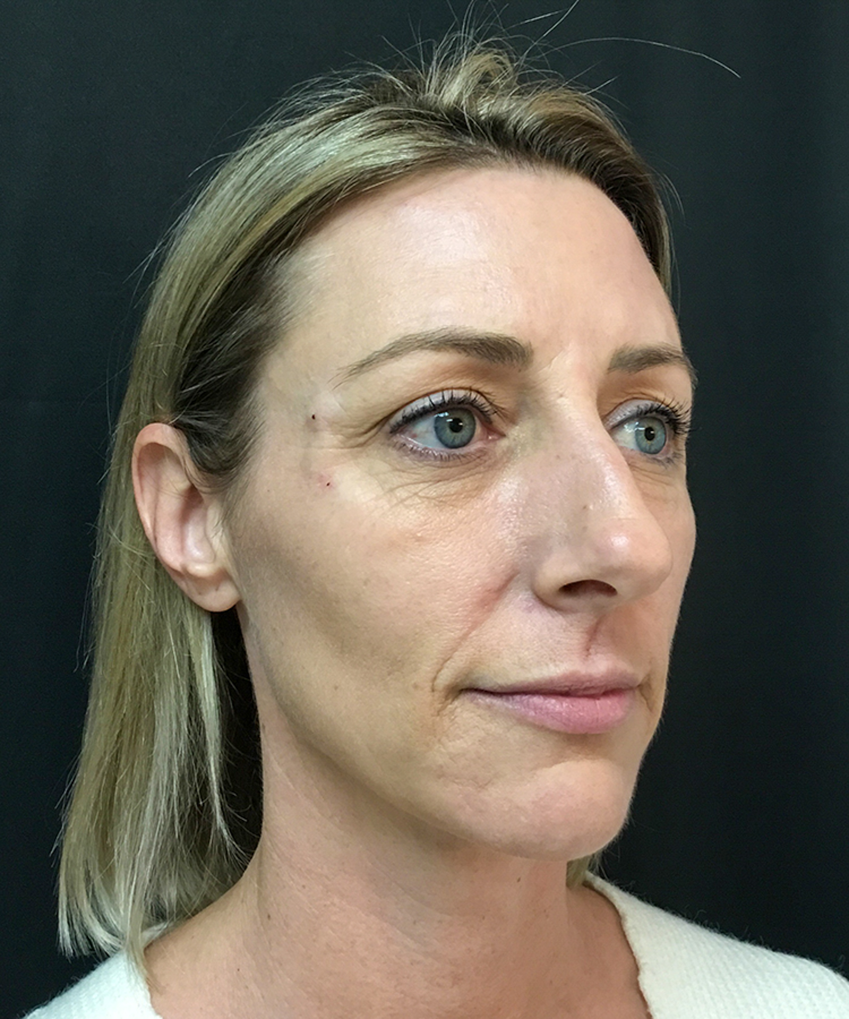 Before and after results of Bellafill treatment showing smoother skin and improved appearance of acne scars or wrinkles.